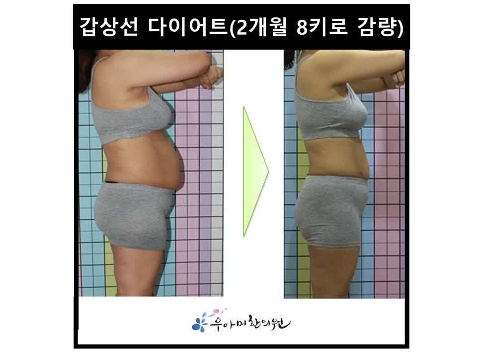 갑상선암 수술 선물 후유증을 방지하고 체력을 회복하려면?