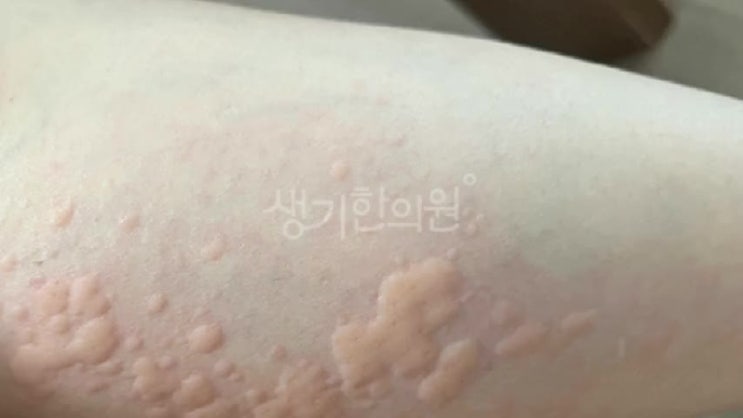 피부붉은발진, 가려움이 갑자기 나타난다면 : 네이버 블로그
