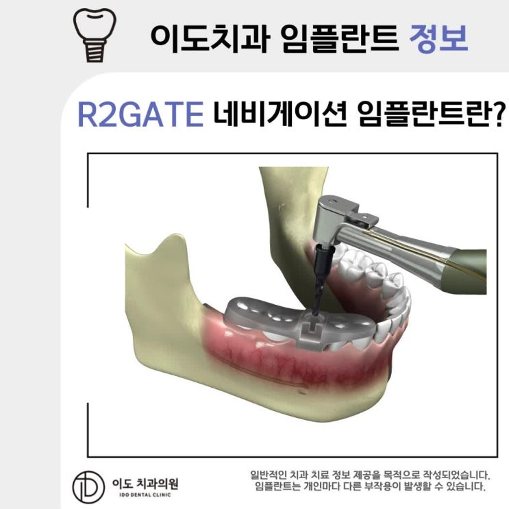 세종 나성동 임플란트 R2GATE 네비게이션 임플란트란? : 네이버 블로그