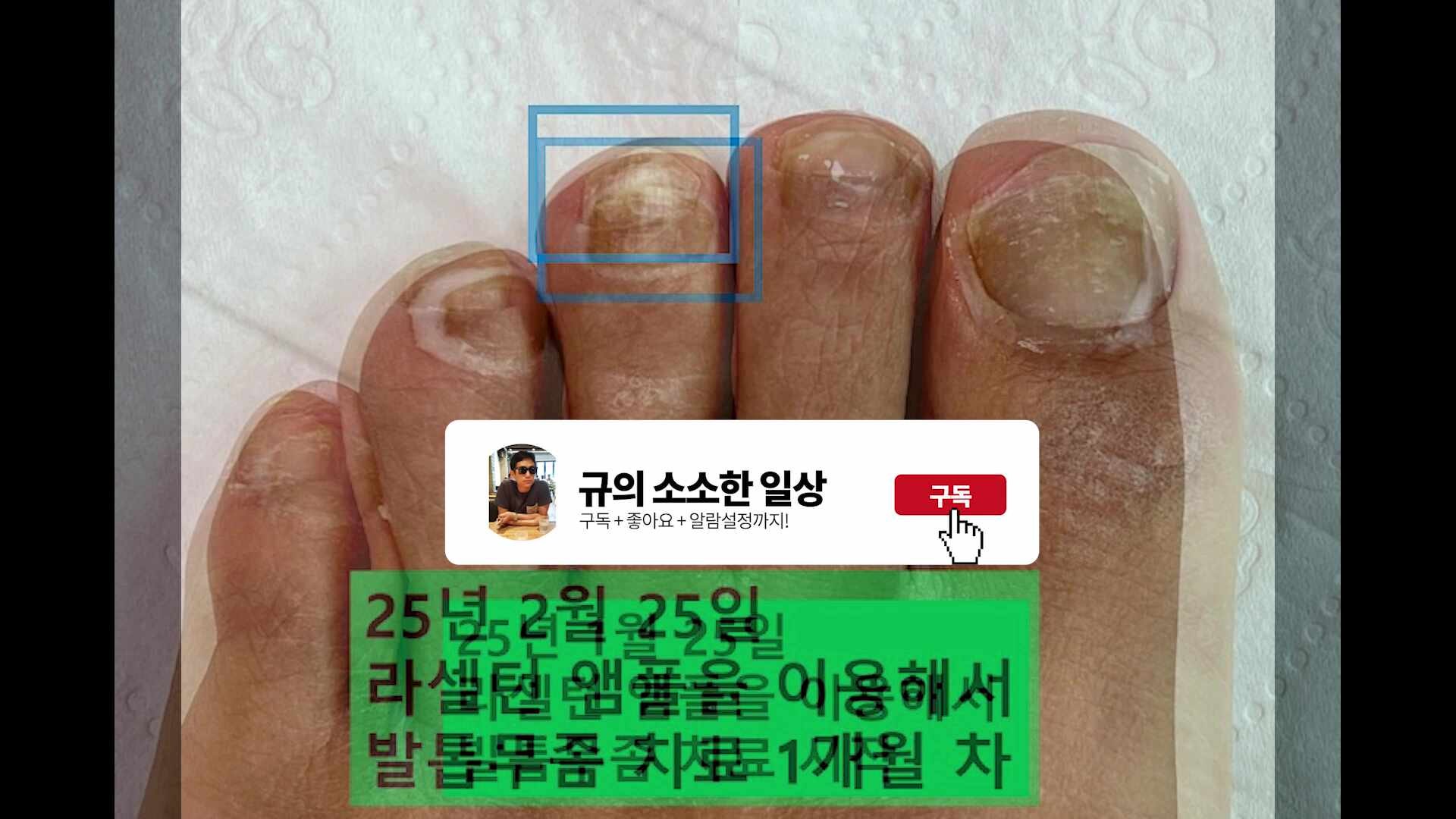 “라셀턴 앰플 8개월 리얼 후기｜발톱무좀, 효과는 느리지만 확실히 달라진 점”