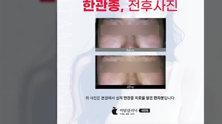 아그네스레이저로 대전한관종 제거, 피부 손상은 최소화하고 깔끔하게!
