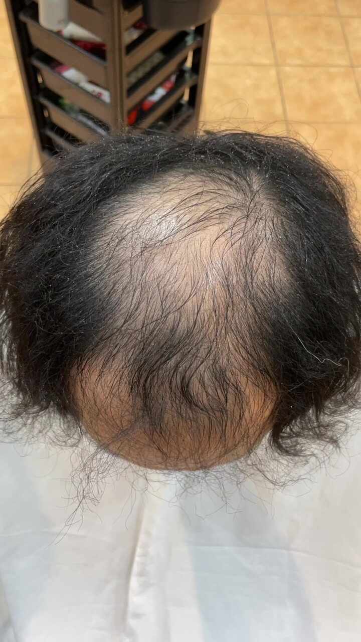  탈모대박사건 방송나온 탈모전문미용실 르네시떼부산사상 전국에서관심폭팔 /부산경남경북남해거제제주전남전북충남충북경기강원서울