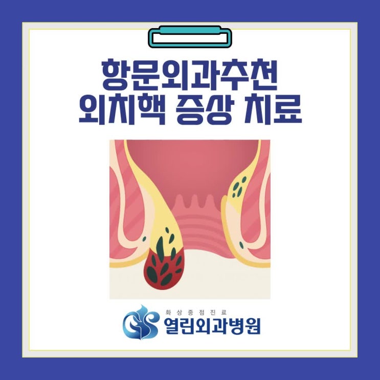 항문외과추천, 외치핵 증상·치료·예방까지 한 번에 정리 : 네이버 블로그