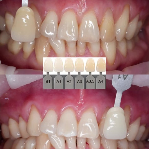 목동나무치과 치아미백 사례 1~4