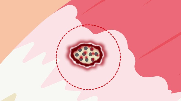 회전근개 부분파열, 축소봉합술과 골수자극재생술을 함께 하면 더 좋아질까요?