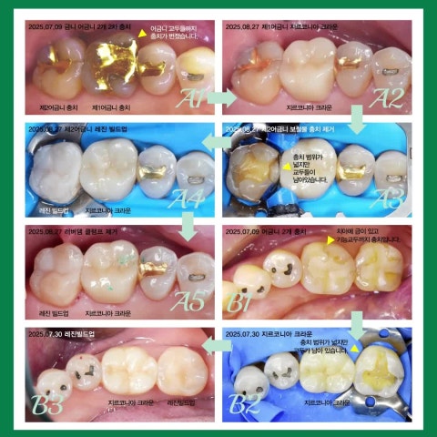 레진 빌드업이 가능한 경우, 크라운 보철이 더 나은 경우.