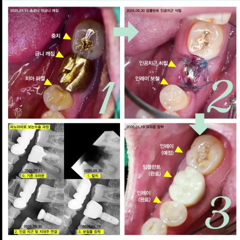 사진으로 자세히 살펴본 임플란트 과정.