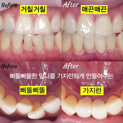 삐뚤삐뚤한 앞니 가지런하게. 크라운 심미 보철.