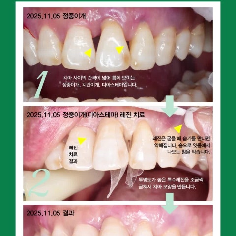 벌어진 앞니, 정중이개, 디아스테마, 레진 빌드업 치료 사례