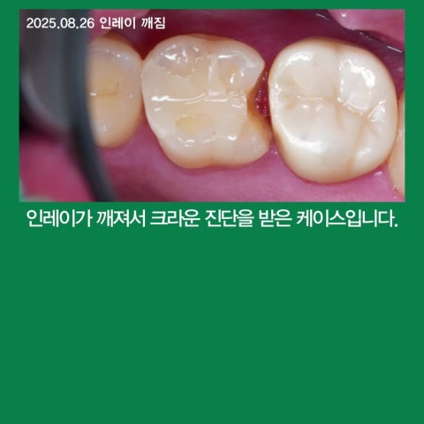 깨진 인레이, 크라운 대신 레진빌드업 치료 사례