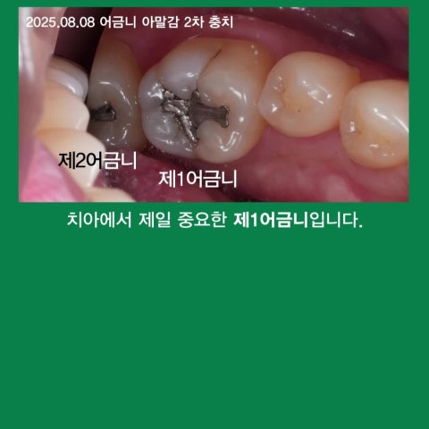 레진에서 인레이, 그리고 크라운, 그 골든타임