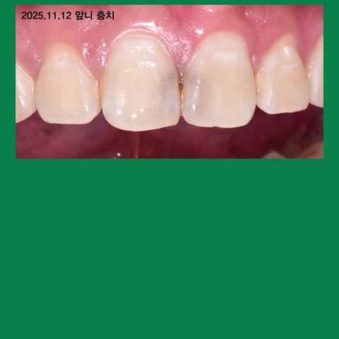 앞니 충치. 레진으로 티 안나게.