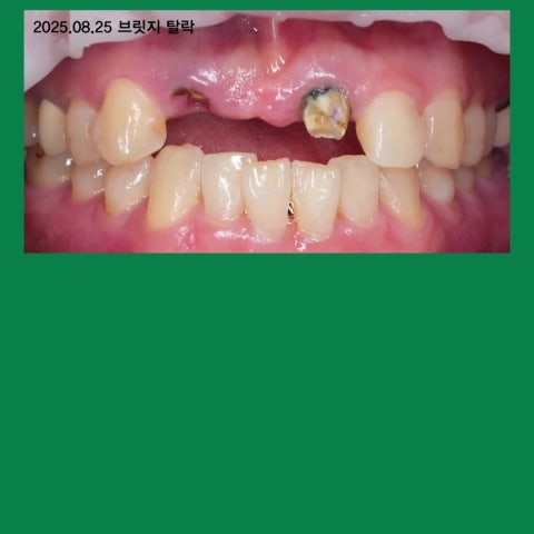 임플란트, 다 심는 게 답이 아닙니다. 앞니 임플란트 브릿지 사례