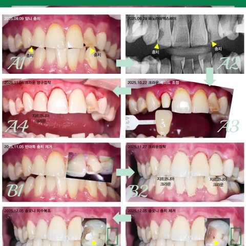 신경치료에서 MTA 치수복조까지. 앞니 보존 치료 사례.