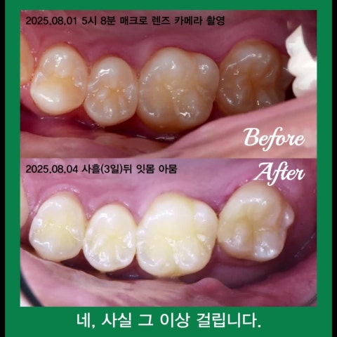 레진 빌드업, 진짜 1시간 넘게 걸리나요? 레진 빌드업, 자세한 치료 과정