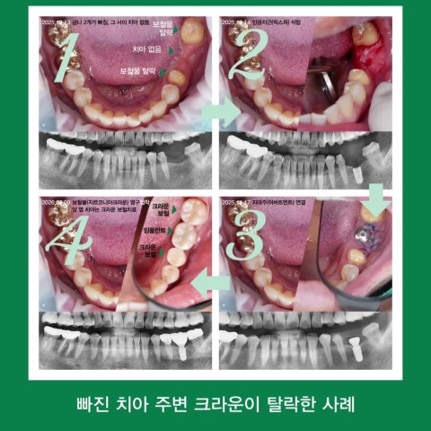 치아는 빈 공간을 내버려두지 않습니다. 빠진 치아 주변의 금니가 탈락하여 내원하신 사례