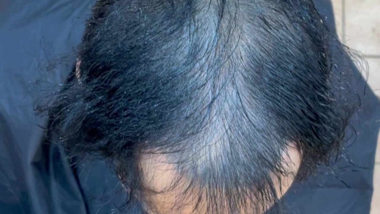  “두피페인팅도 포기했던 남자 정수리탈모… 2022년 토탈탈모성형펌 이후 지금까지 3년째 단골된 이유｜부산 사상 탈모헤어미용 클리닉 전문”/ 경남경북김해남해밀양전라전북구미포항마산