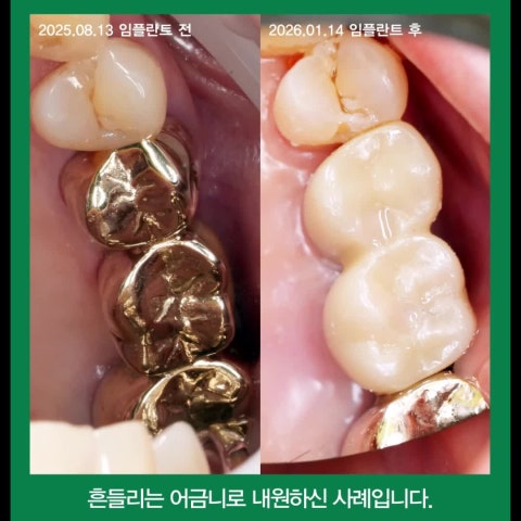 외팔보 브릿지의 위험성, 연결 임플란트의 장단점, 임플란트 사례.