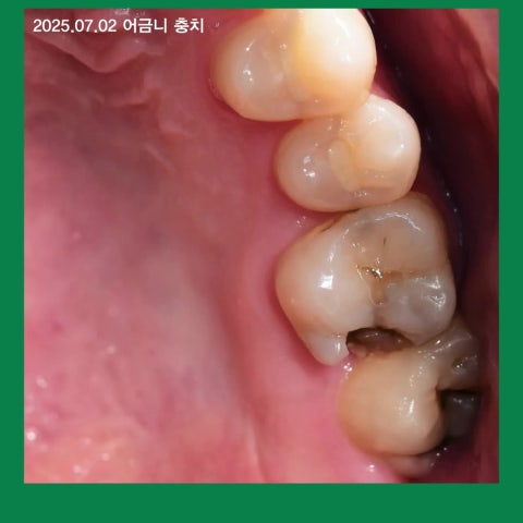 신경치료 대신 MTA 치수복조가 가능한 경우