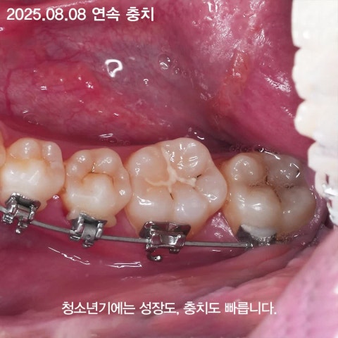 청소년 충치를 예방하는 4가지 방법