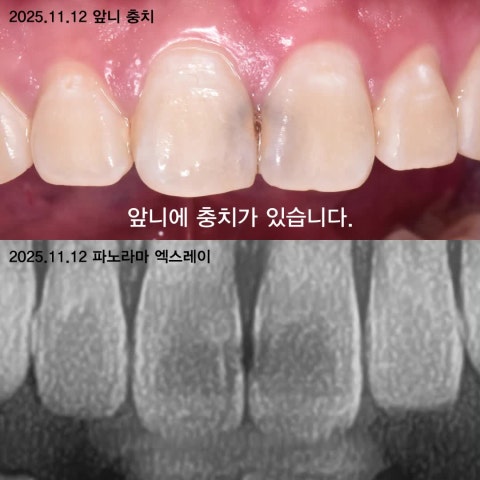 앞니 충치 치아 뒤쪽에서 제거하는 이유. 앞니 충치 레진 치료 사례.