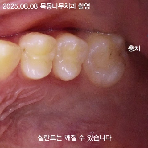 실란트 한 후에는 1년에 2번 정기검진 필수입니다.