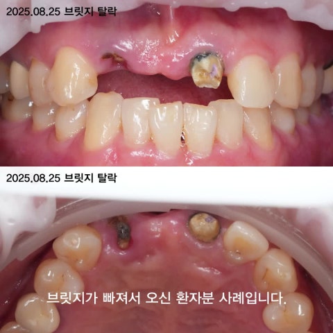 빠진 앞니 브릿지 재치료, 앞니 임플란트 숫자를 줄이는 이유