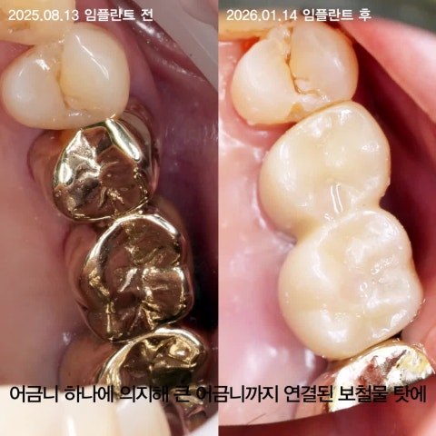 어금니 외팔보 브릿지는 위험합니다. 그리고, 치아가 빠진 자리의 잇몸뼈는 줄어듭니다. 임플란트 사례