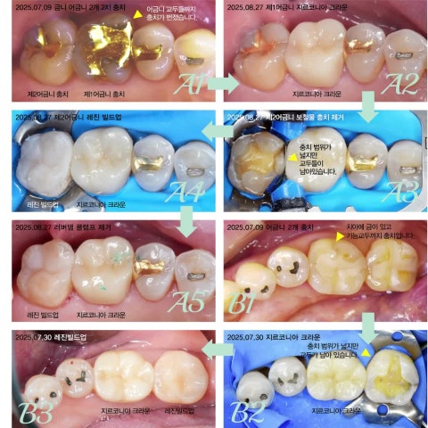 레진빌드업이 가능한 경우, 크라운을 해야 하는 경우