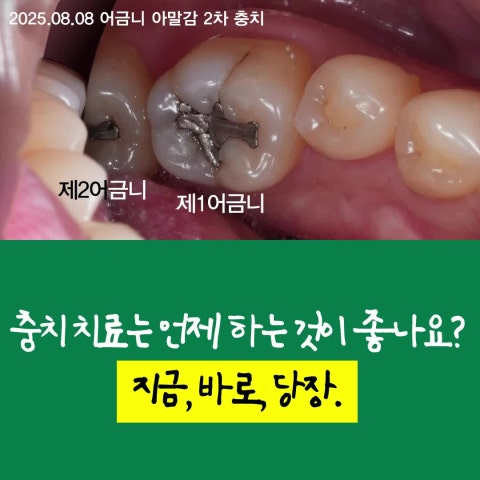 레진 대신 인레이, 인레이 대신 크라운을 해야하는 경우