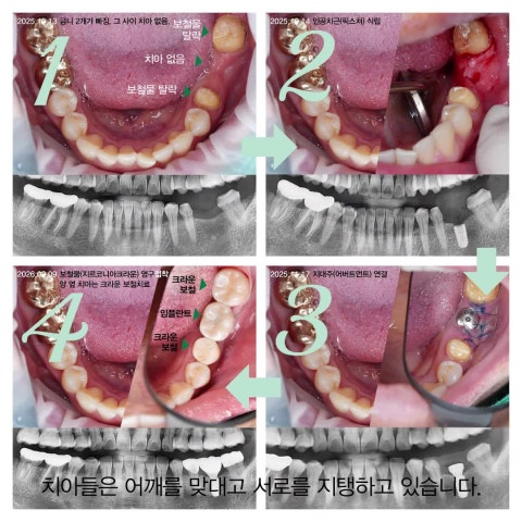 치아가 빠진 자리를 비워두면 옆 치아, 맞닿는 치아에 문제가 생깁니다.