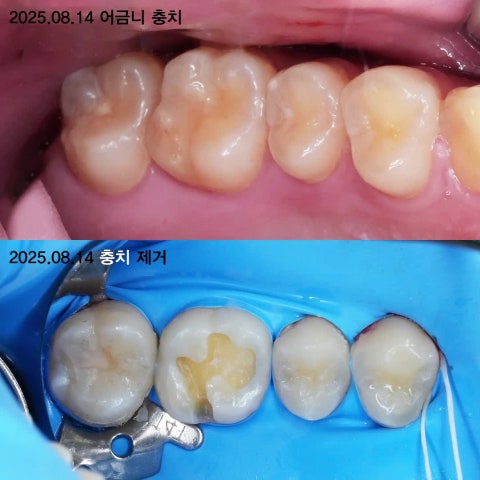 레진빌드업: 충치만 깍으니 강아지가 되네요.