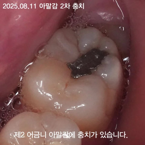 아말감을 더 이상 사용하지 않는 이유