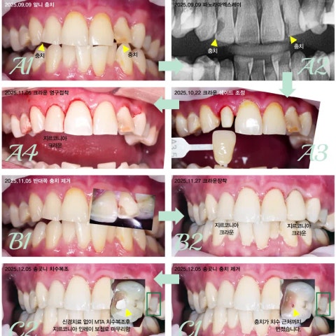 신경치료부터 MTA 치수복조까지: 맞춤형 보존 치료