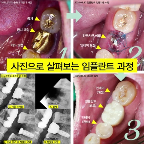 사진으로 살펴보는 네비게이션 임플란트 과정