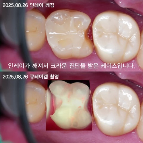 깨진 인레이 레진빌드업으로 치료하기. 양쪽 인접면 빌드업 사례
