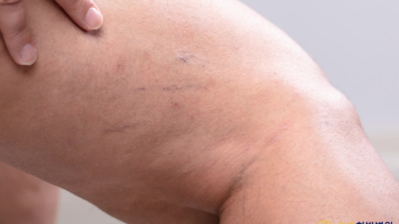 마산하지정맥류 자다가 난 단순 경련일까요, 혈관의 경고일까요?