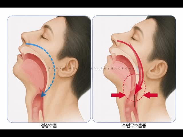 천안 수면무호흡, 어떤 치료가 필요한가요?