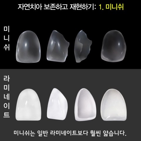 자연치아를 보존하고 복원합니다: 미니쉬, 레진빌드업, ...