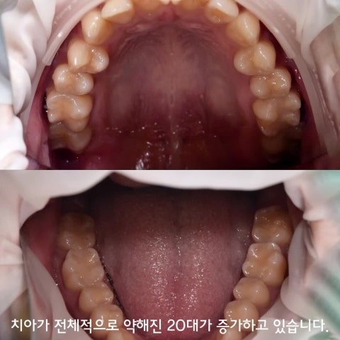 20대 치아 부식 주의보! 제로 탄산과 배달 음식이 치아를 녹인다.