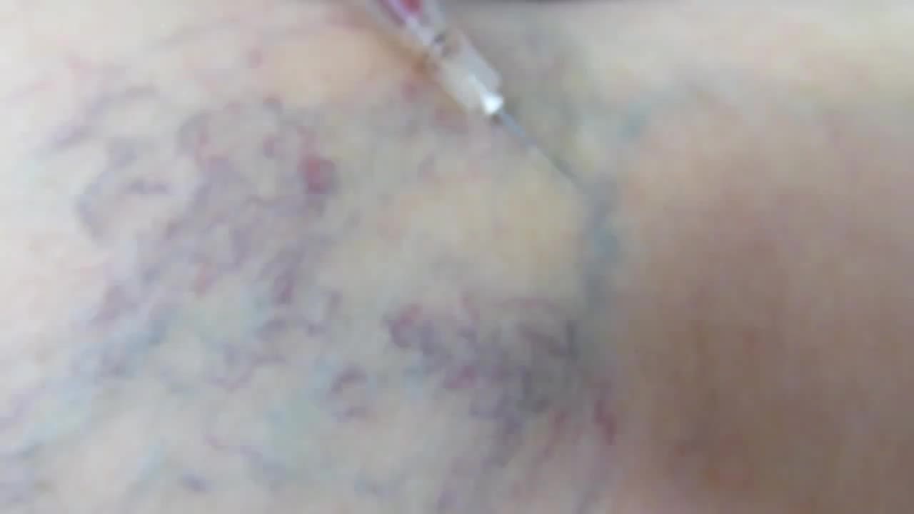 하지정맥류 수술 후 부작용·재발 확률은? 관리법(운동, 찜질, 음식) 총정리