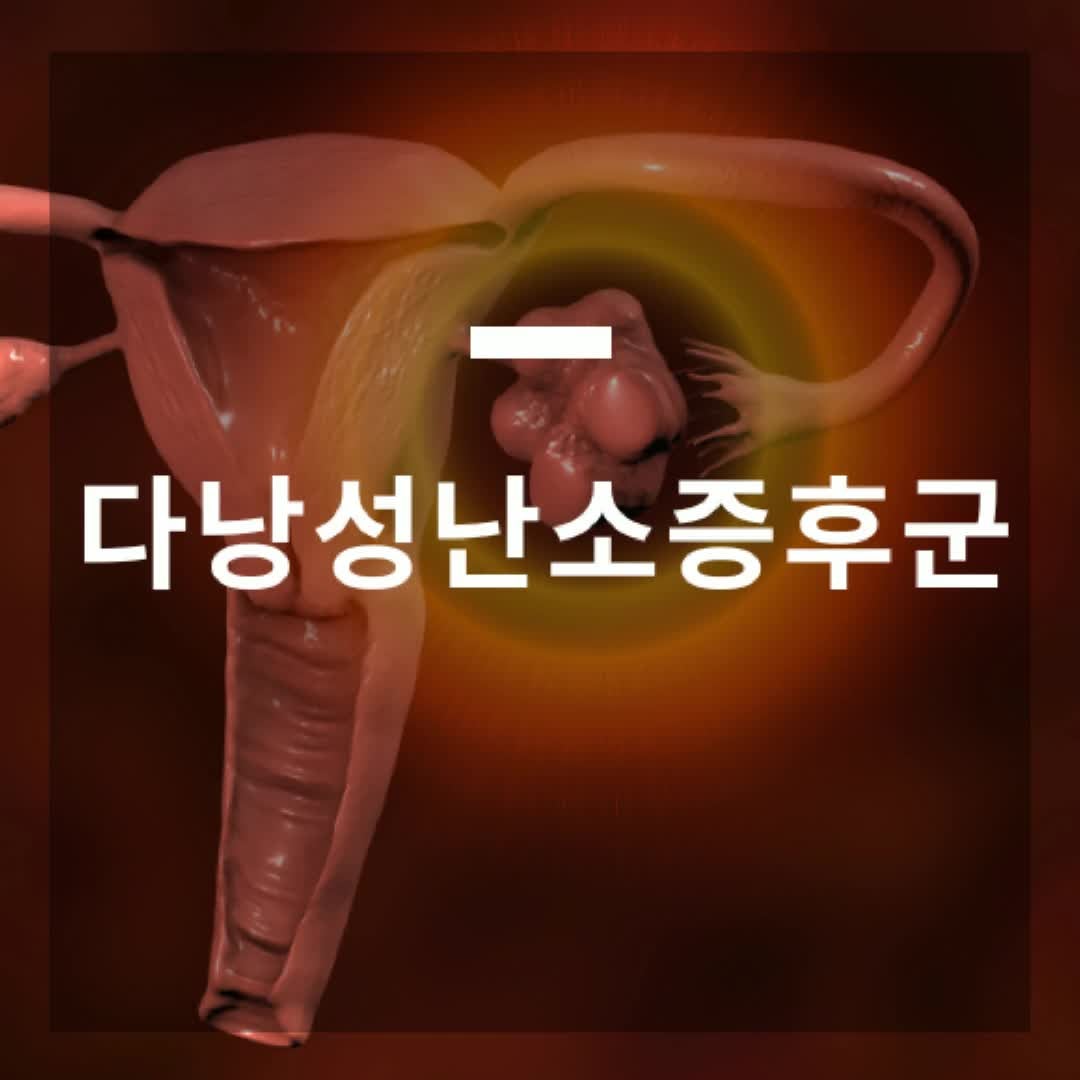 다낭성난소증후군 증상 검사 치료하면 임신될까?