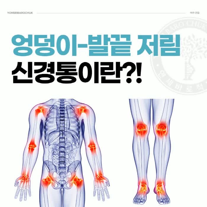 좌골신경통병원 증상부터 치료까지 한 눈에 정리 – 성동구신경외과
