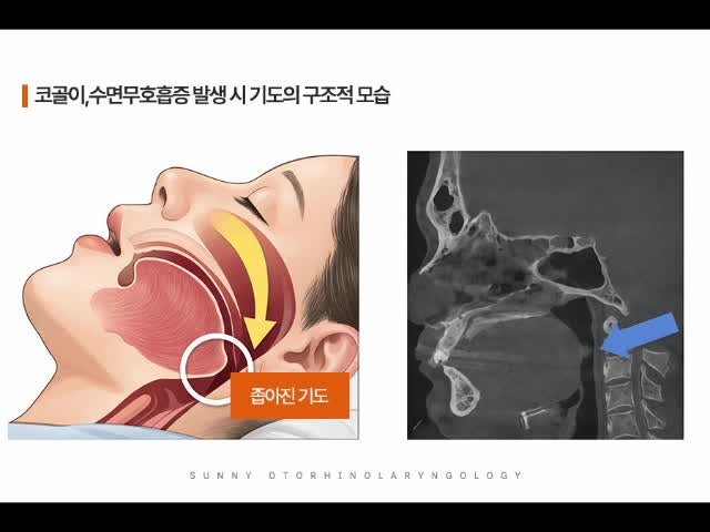 커지는 코골이 소리 개선하려면 필요한 과정, 천안수면클리닉, 수면센터, 수면다원검사