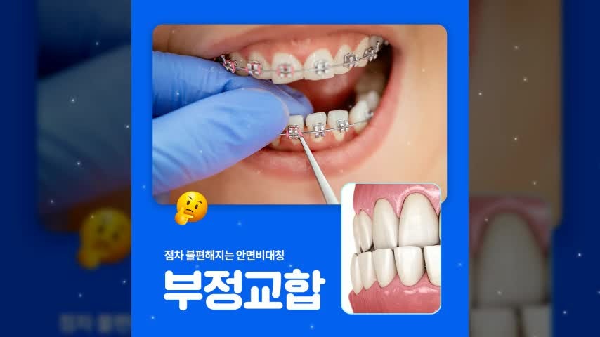 삼산동교정치과추천 부정교합 치아교정 원인부터 주의사항까지 요약정리