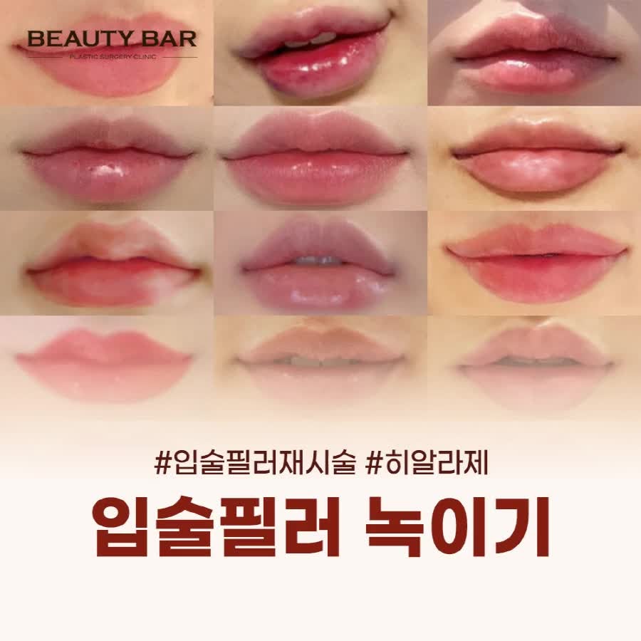 신사 입술필러녹이기 후 재시술, 녹여야 하는 케이스 3가지