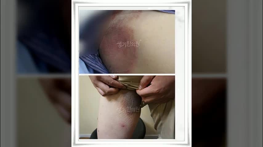 해운대 백선증, 겨드랑이·사타구니 단순한 땀띠가 아닐 수 있습니다