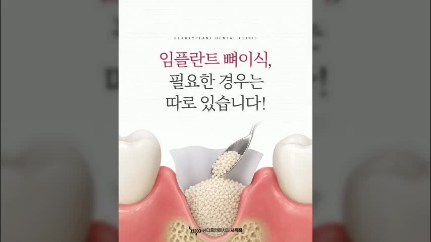 미남역치과, 임플란트 뼈이식이 필요한 경우 총정리