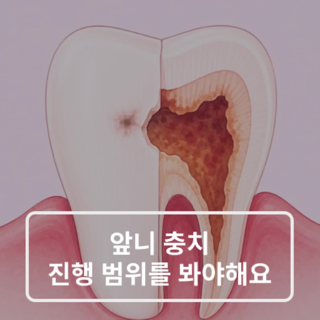홍제3동충치치료, 앞니 충치는 ‘보이는 자국’보다 진행 범위를 먼저 봐야 합니다