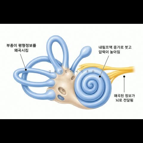 대구어지럼증과 귀 먹먹함이 동시에 나타난다면